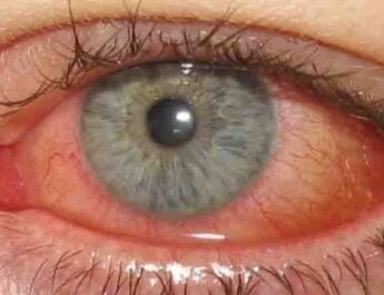 conjuntivitis