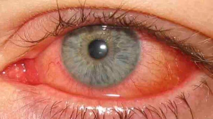 conjuntivitis
