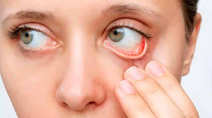 Recomendaciones para prevenir la conjuntivitis 1 la conjuntivitis